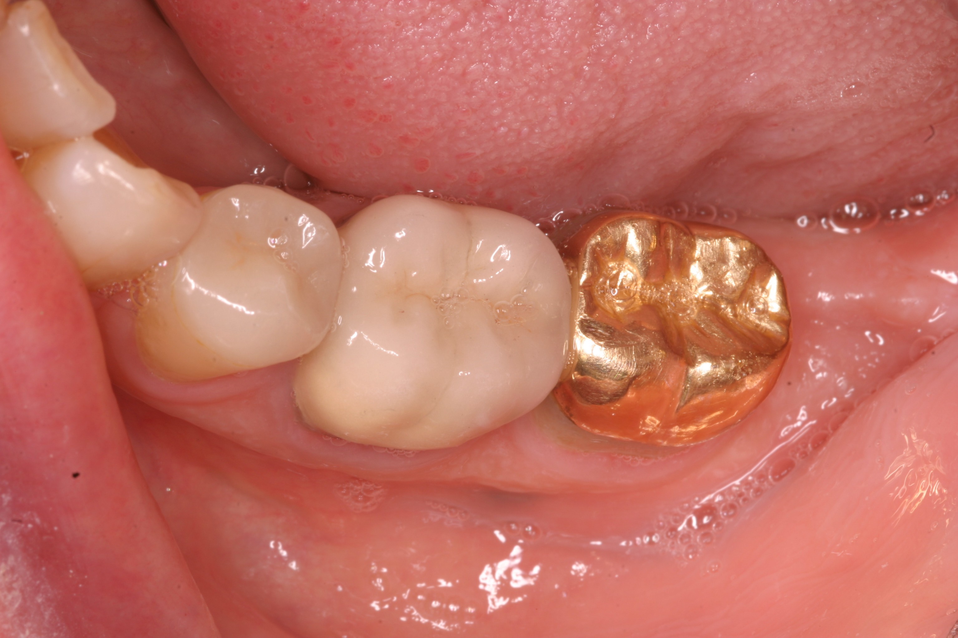 restoration dental