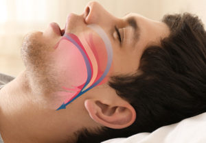 Read more about the article Sleep Apnea Questionnaire